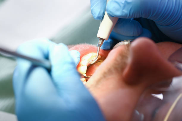 Best Emergency Wisdom Teeth Removal in Ogden, IA