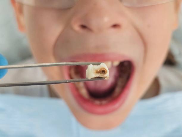 Best Emergency Tooth Extraction in Ogden, IA